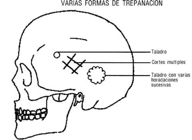 Curarte la cabeza haciéndote un agujero... La trepanación en la Antigüedad